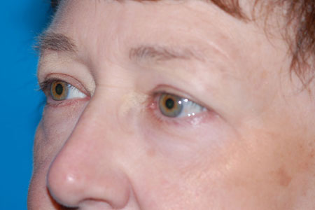 Closeup of a woman's eyes before a facelift
