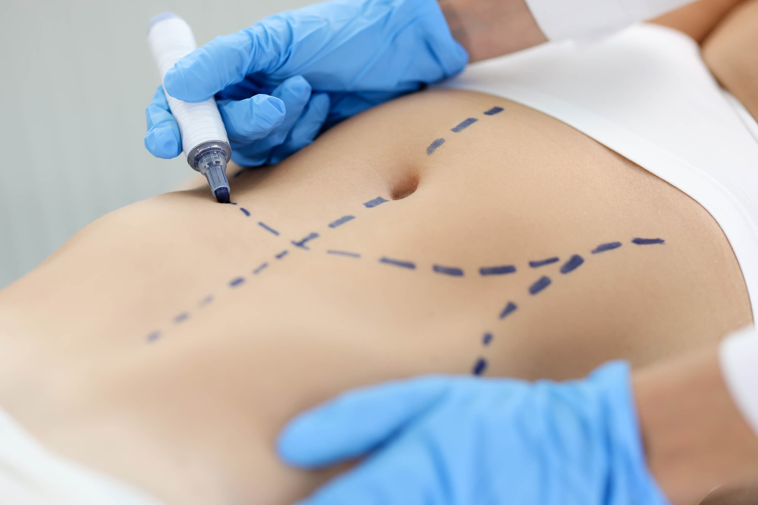 A surgeon marks a patient's abdomen prior to an abdominoplasty, more commonly known as a tummy tuck.