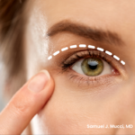 Eyelid Surgery