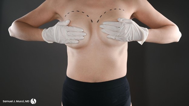 Fat Grafting in Breast Augmentation